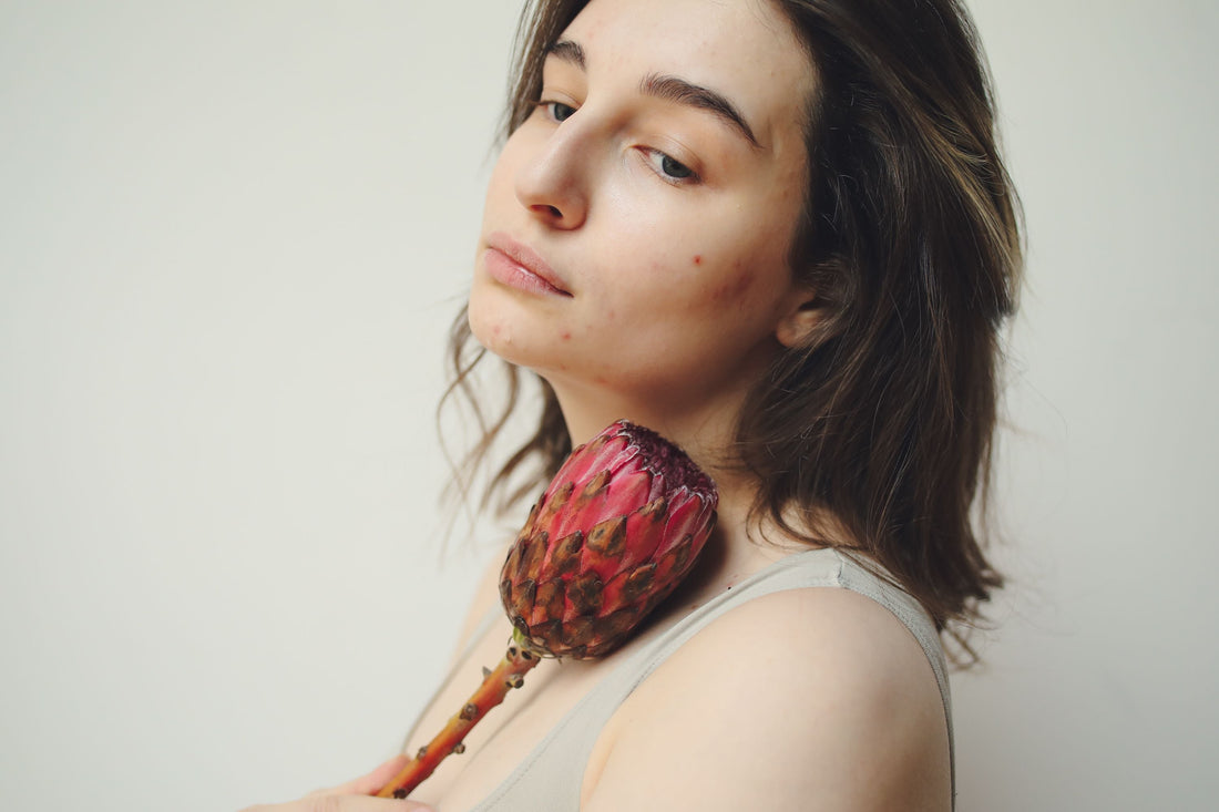 A softly lit close-up portrait of a young woman with visible acne, wearing a gray top and holding a vivid red protea flower against her shoulder, set against a plain background.
